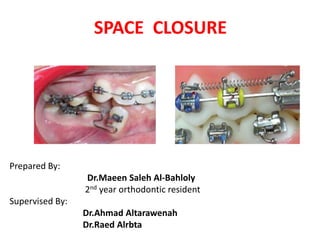 SPACE CLOSURE
Prepared By:
Dr.Maeen Saleh Al-Bahloly
2nd year orthodontic resident
Supervised By:
Dr.Ahmad Altarawenah
Dr.Raed Alrbta
 