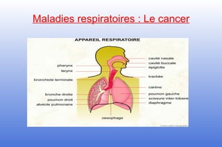 Maladies respiratoires : Le cancer
 