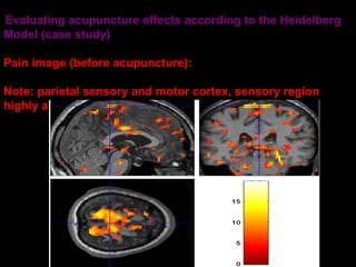 Evaluating acupuncture effects according to the Heidelberg
Model (case study)
Pain image (before acupuncture):
Note: parietal sensory and motor cortex, sensory region
highly active
Acup 4 tif

27

 