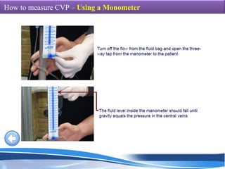 Measuring Cvp With Ruler Magdi m.med.icu pro-oo6-ppt | PPSX