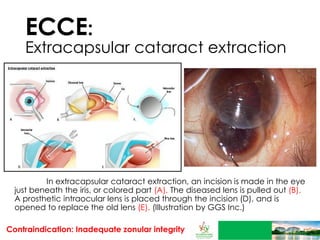 Magement of cataract | PDF
