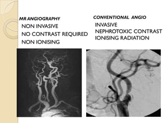 MR ANGIOGRAPHY
NON INVASIVE
NO CONTRAST REQUIRED
NON IONISING
INVASIVE
NEPHROTOXIC CONTRAST
IONISING RADIATION
CONVENTIONAL ANGIO
 