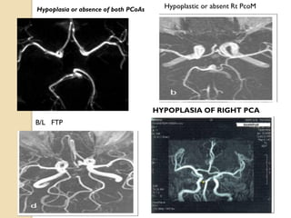 Hypoplasia or absence of both PCoAs
HYPOPLASIA OF RIGHT PCA
B/L FTP
Hypoplastic or absent Rt PcoM
 