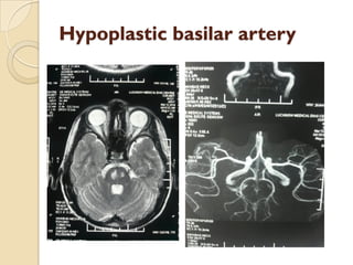 Hypoplastic basilar artery
 