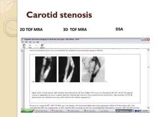 Carotid stenosis
2D TOF MRA 3D TOF MRA DSA
 