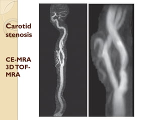 Carotid
stenosis
CE-MRA
3DTOF-
MRA
 
