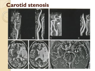 Carotid stenosis
 