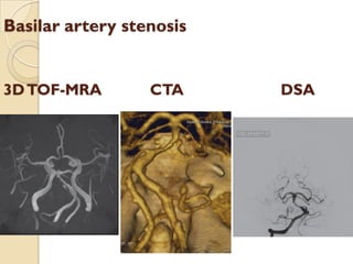Basilar artery stenosis
3DTOF-MRA CTA DSA
 