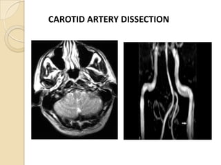 CAROTID ARTERY DISSECTION
 