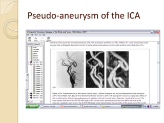 Pseudo-aneurysm of the ICA
 