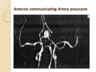 Anterior communicating Artery aneurysm
 