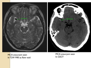 MCA aneurysm seen
InT2W MRI as flow void
MCA aneurysm seen
In CECT
 