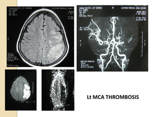 Lt MCA THROMBOSIS
 