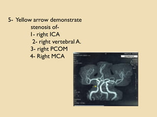 5- Yellow arrow demonstrate
stenosis of-
1- right ICA
2- right vertebral A.
3- right PCOM
4- Right MCA
 