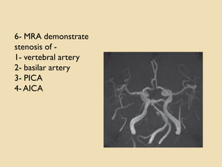6- MRA demonstrate
stenosis of -
1- vertebral artery
2- basilar artery
3- PICA
4- AICA
 
