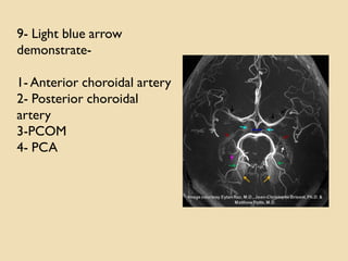9- Light blue arrow
demonstrate-
1- Anterior choroidal artery
2- Posterior choroidal
artery
3-PCOM
4- PCA
 