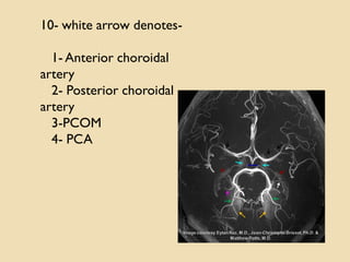 10- white arrow denotes-
1- Anterior choroidal
artery
2- Posterior choroidal
artery
3-PCOM
4- PCA
 