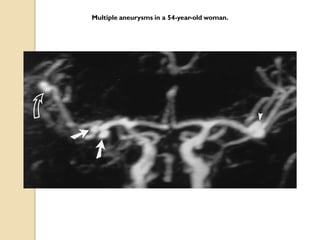 Multiple aneurysms in a 54-year-old woman.
 