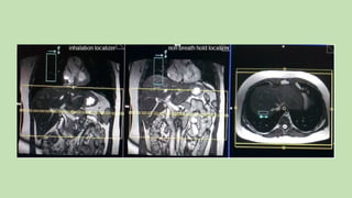 MAGNETIC_RESONANCE_CHOLANGIOPANCREATOGRAPHY_(MRCP)[1].pptx