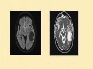 Magnetic Resonance Diffusion Weighted Imaging | PPT