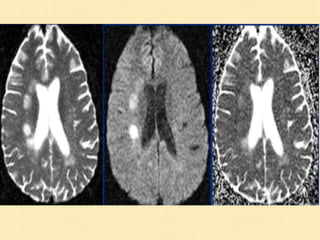 Magnetic Resonance Diffusion Weighted Imaging | PPT