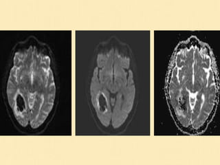 Magnetic Resonance Diffusion Weighted Imaging | PPT