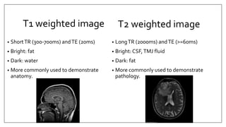 T1 weighted image
• ShortTR (300-700ms) andTE (20ms)
• Bright: fat
• Dark: water
• More commonly used to demonstrate
anatomy.
• LongTR (2000ms) andTE (>=60ms)
• Bright: CSF,TMJ fluid
• Dark: fat
• More commonly used to demonstrate
pathology.
T2 weighted image
 