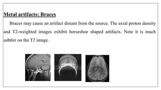 Metal artifacts: Braces
Braces may cause an artifact distant from the source. The axial proton density
and T2-weighted images exhibit horseshoe shaped artifacts. Note it is much
subtler on the T2 image.
 