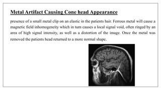 Metal Artifact Causing Cone head Appearance
presence of a small metal clip on an elastic in the patients hair. Ferrous metal will cause a
magnetic field inhomogeneity which in turn causes a local signal void, often ringed by an
area of high signal intensity, as well as a distortion of the image. Once the metal was
removed the patients head returned to a more normal shape.
 