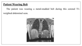 Patient Wearing Belt
The patient was wearing a metal-studded belt during this coronal T1-
weighted abdominal scan.
 