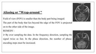 Aliasing or "Wrap-around "
Field of view (FOV) is smaller than the body part being imaged.
The part of the body that lies beyond the edge of the FOV is projected
on to the other side of the image.
REMEDY :
 By over sampling the data. In the frequency direction, sampling the
signal twice as fast. In the phase direction, the number of phase-
encoding steps must be increased.
 