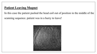 Patient Leaving Magnet
In this case the patient pushed the head coil out of position in the middle of the
scanning sequence. patient was in a hurry to leave!
 