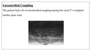 Uncontrolled Coughing
The patient had a fit of uncontrolled coughing during this axial T1-weighted
lumbar spine scan.
 