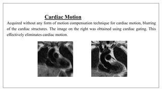 Cardiac Motion
Acquired without any form of motion compensation technique for cardiac motion, blurring
of the cardiac structures. The image on the right was obtained using cardiac gating. This
effectively eliminates cardiac motion.
 