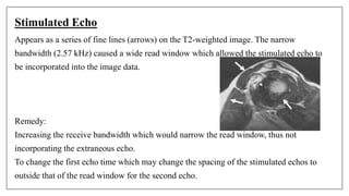 Stimulated Echo
Appears as a series of fine lines (arrows) on the T2-weighted image. The narrow
bandwidth (2.57 kHz) caused a wide read window which allowed the stimulated echo to
be incorporated into the image data.
Remedy:
Increasing the receive bandwidth which would narrow the read window, thus not
incorporating the extraneous echo.
To change the first echo time which may change the spacing of the stimulated echos to
outside that of the read window for the second echo.
 