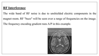 RF Interference
The wide band of RF noise is due to unshielded electric components in the
magnet room. RF "buzz" will be seen over a range of frequencies on the image.
The frequency encoding gradient runs A/P in this example.
 