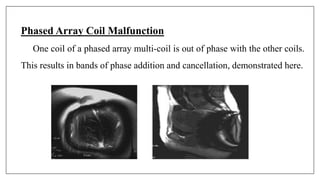 Phased Array Coil Malfunction
One coil of a phased array multi-coil is out of phase with the other coils.
This results in bands of phase addition and cancellation, demonstrated here.
 