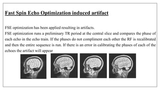 Fast Spin Echo Optimization induced artifact
FSE optimization has been applied resulting in artifacts.
FSE optimization runs a preliminary TR period at the central slice and compares the phase of
each echo in the echo train. If the phases do not compliment each other the RF is recalibrated
and then the entire sequence is run. If there is an error in calibrating the phases of each of the
echoes the artifact will appear
 