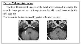 Partial Volume Averaging
The two T1-weighted images of the head were obtained at exactly the
same location, yet the second image shows the VII cranial nerve while the
first does not.
The reason for the is explained by partial volume averaging.
 