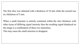 The first slice was obtained with a thickness of 10 mm while the second was
at a thickness of 3 mm.
When a small structure is entirely contained within the slice thickness with
other tissue of differing signal intensity then the resulting signal displayed on
the image is a combination of these two intensities.
This may cause the small structure to disappear.
 