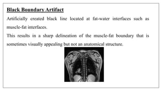 Black Boundary Artifact
Artificially created black line located at fat-water interfaces such as
muscle-fat interfaces.
This results in a sharp delineation of the muscle-fat boundary that is
sometimes visually appealing but not an anatomical structure.
 