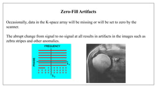 Zero-Fill Artifacts
Occasionally, data in the K-space array will be missing or will be set to zero by the
scanner.
The abrupt change from signal to no signal at all results in artifacts in the images such as
zebra stripes and other anomalies.
 