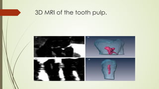 3D MRI of the tooth pulp.
 