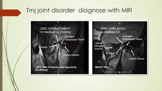 Tmj joint disorder diagnose with MRI
 