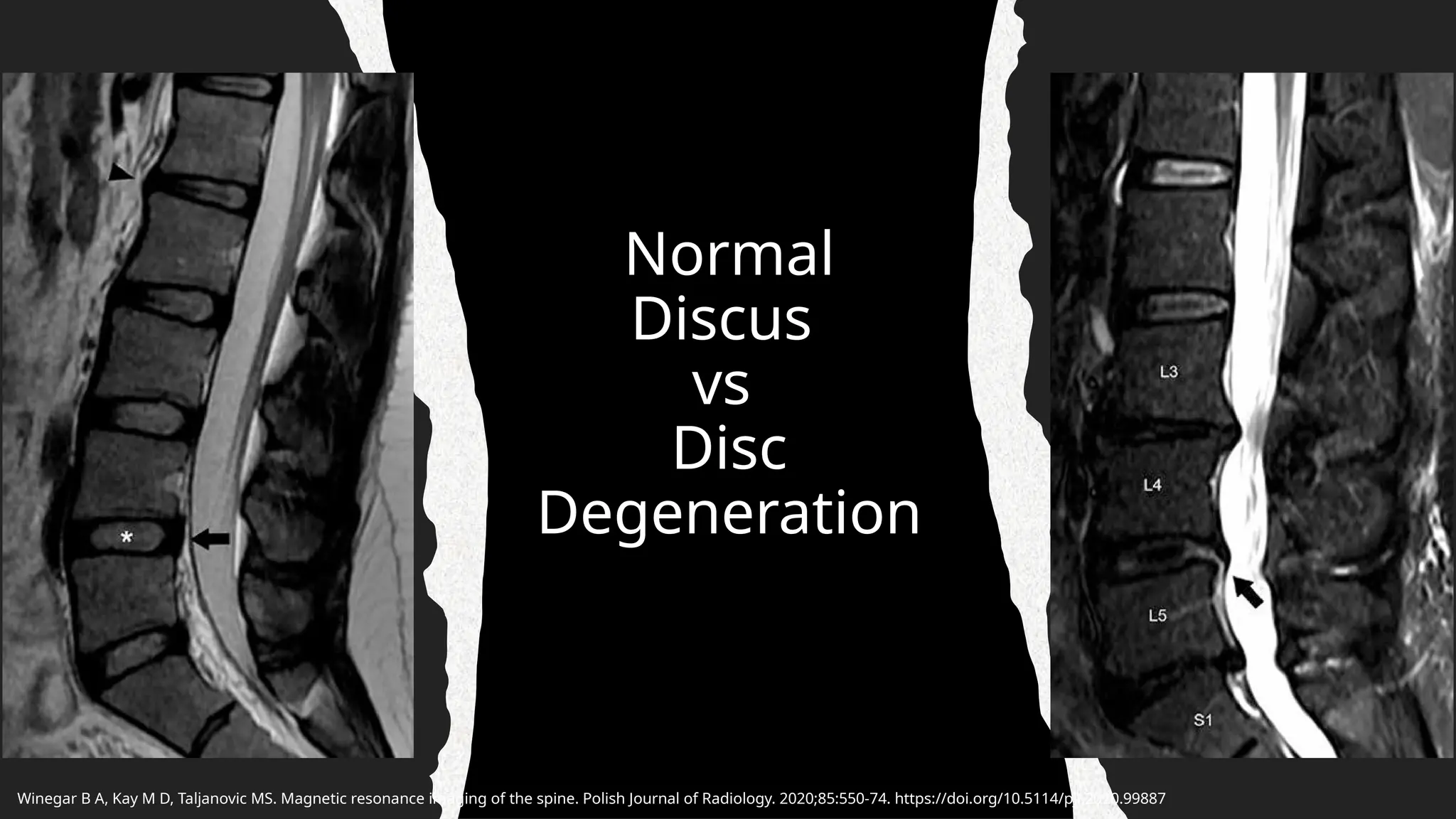 Magnetic Resonance Imaging of Spine.pptx