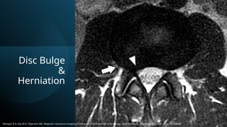 Magnetic Resonance Imaging of Spine.pptx