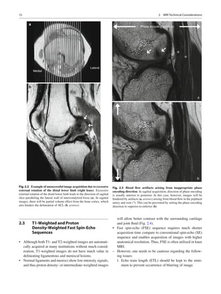 Magnetic resonance imaging of the knee | PDF