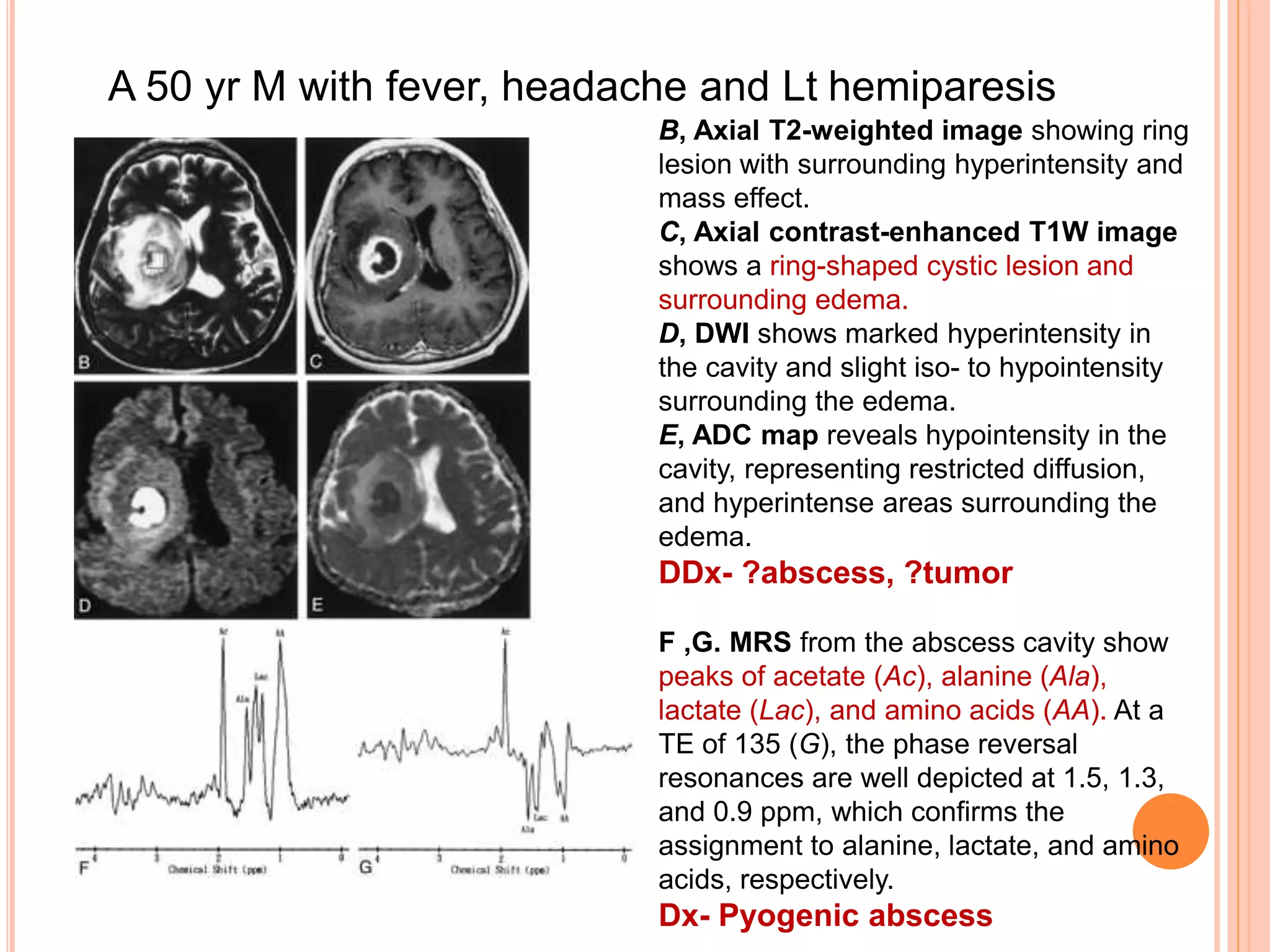 A 50 yr M with fever, headache and Lt hemiparesis
B, Axial T2-weighted image showing ring
lesion with surrounding hyperintensity and
mass effect.
C, Axial contrast-enhanced T1W image
shows a ring-shaped cystic lesion and
surrounding edema.
D, DWI shows marked hyperintensity in
the cavity and slight iso- to hypointensity
surrounding the edema.
E, ADC map reveals hypointensity in the
cavity, representing restricted diffusion,
and hyperintense areas surrounding the
edema.
DDx- ?abscess, ?tumor
F ,G. MRS from the abscess cavity show
peaks of acetate (Ac), alanine (Ala),
lactate (Lac), and amino acids (AA). At a
TE of 135 (G), the phase reversal
resonances are well depicted at 1.5, 1.3,
and 0.9 ppm, which confirms the
assignment to alanine, lactate, and amino
acids, respectively.
Dx- Pyogenic abscess
 