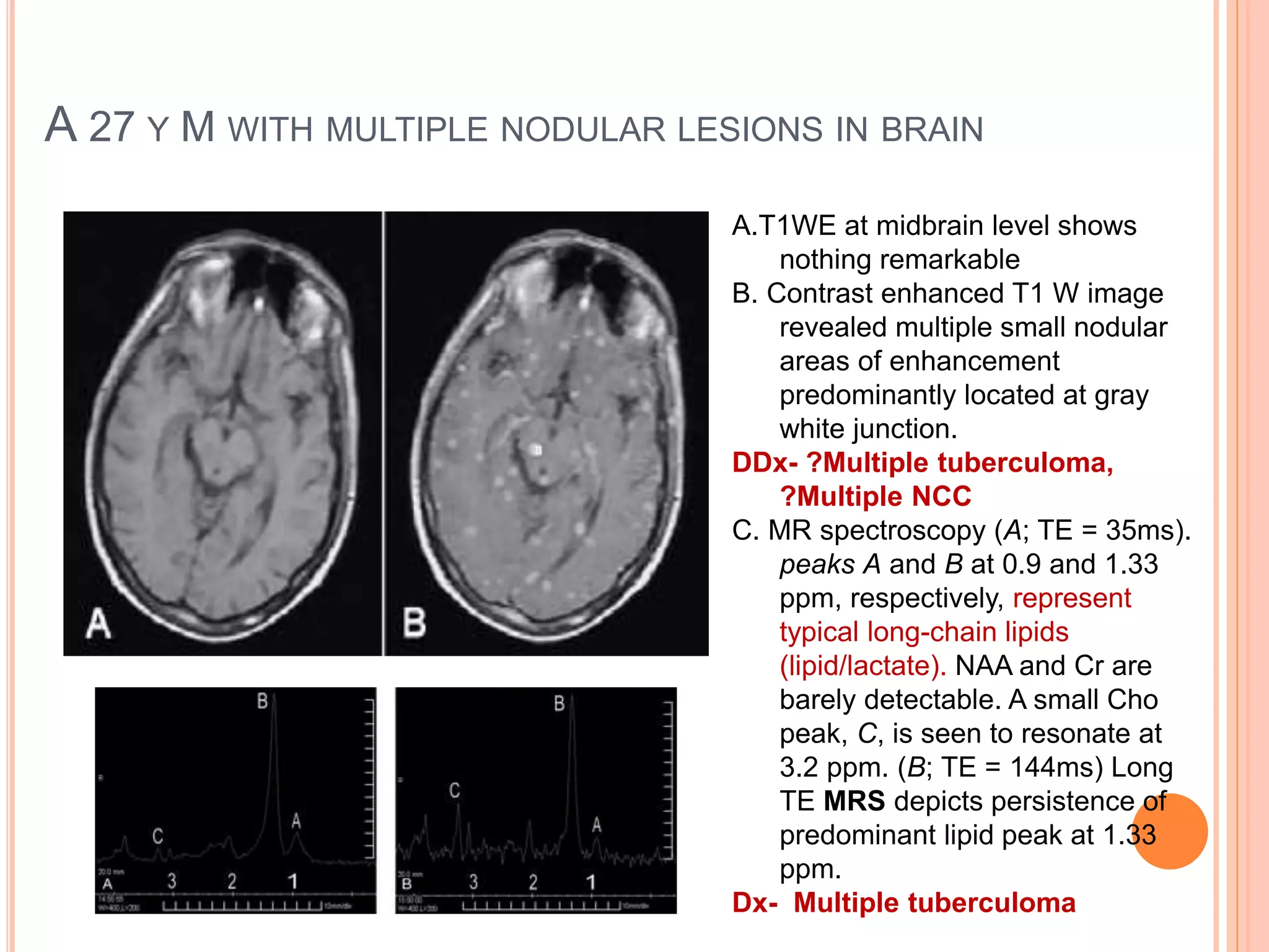 A 27 Y M WITH MULTIPLE NODULAR LESIONS IN BRAIN
A.T1WE at midbrain level shows
nothing remarkable
B. Contrast enhanced T1 W image
revealed multiple small nodular
areas of enhancement
predominantly located at gray
white junction.
DDx- ?Multiple tuberculoma,
?Multiple NCC
C. MR spectroscopy (A; TE = 35ms).
peaks A and B at 0.9 and 1.33
ppm, respectively, represent
typical long-chain lipids
(lipid/lactate). NAA and Cr are
barely detectable. A small Cho
peak, C, is seen to resonate at
3.2 ppm. (B; TE = 144ms) Long
TE MRS depicts persistence of
predominant lipid peak at 1.33
ppm.
Dx- Multiple tuberculoma
 