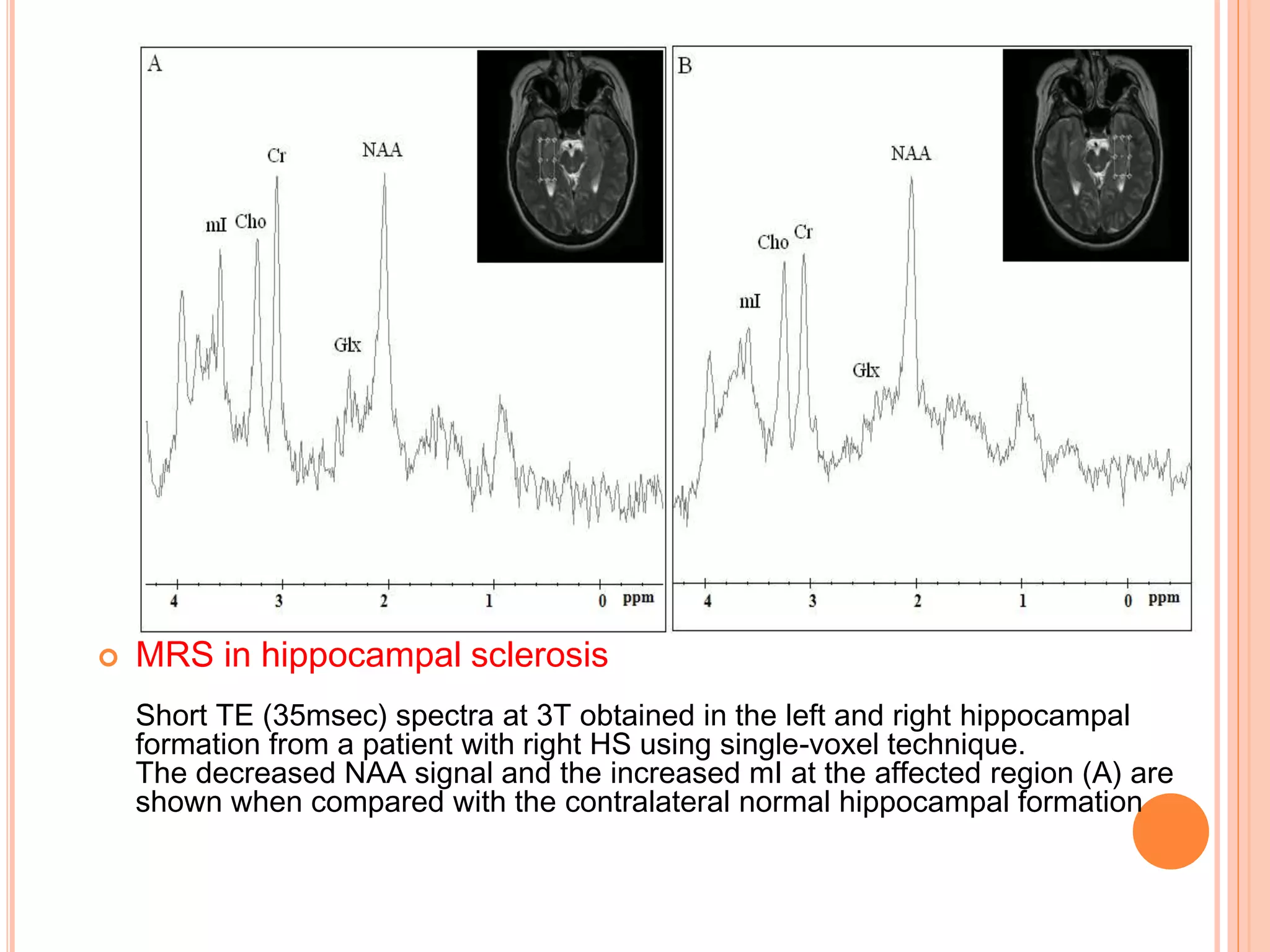  MRS in hippocampal sclerosis
Short TE (35msec) spectra at 3T obtained in the left and right hippocampal
formation from a patient with right HS using single-voxel technique.
The decreased NAA signal and the increased mI at the affected region (A) are
shown when compared with the contralateral normal hippocampal formation
 